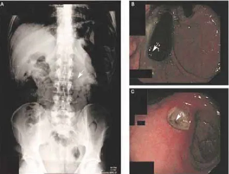 Figura  1. A)  Radiografía  simple  de  abdomen  en  la  que se aprecia  un  objeto ovalado en el cuadrante superior izquierdo (flecha)