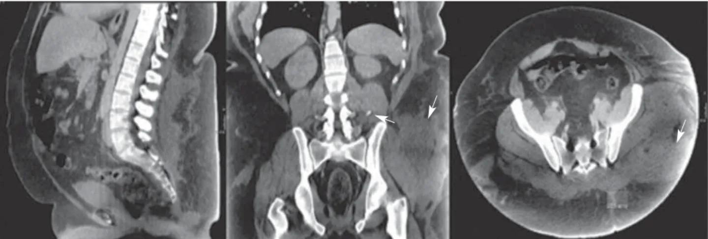 Figura 1. Imágenes obtenidas por tomografía computarizada (TC) de la lesión de desguantamiento cerrada en zona lumbar