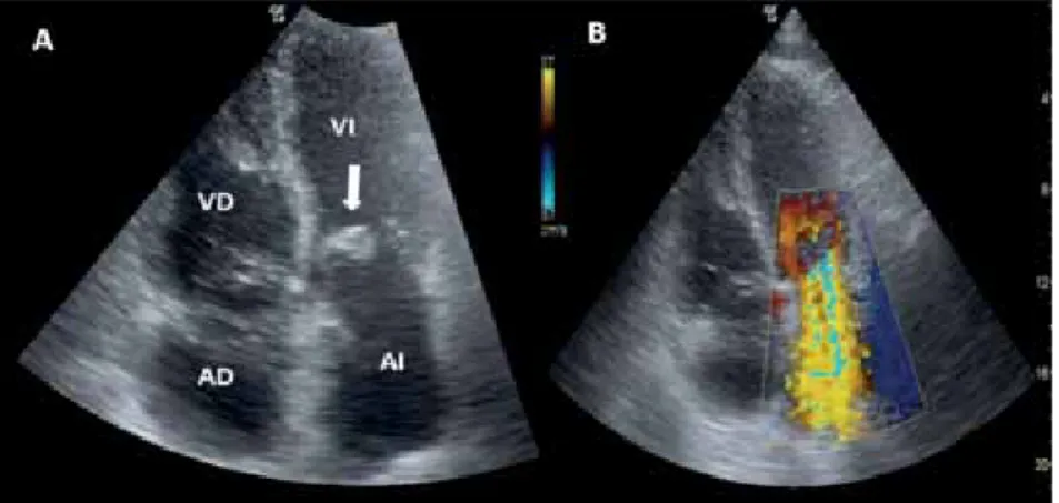 Figura 2. Ecocardiograma realizado por un facultativo de urgencias. A. Plano paraes- paraes-ternal longitudinal que muestra la presencia de un derrame pericárdico grave de  predo-minio posterior y una dilatación de la aorta ascendente con una imagen hipere