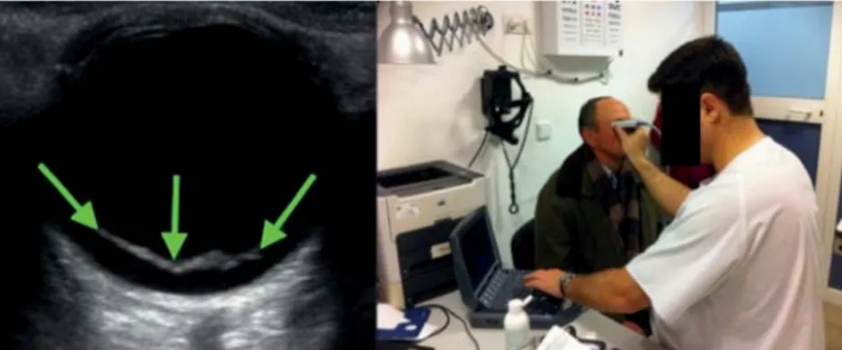 Figura 1. Omagen ecográfica del ojo derecho del paciente, en la que se aprecia una lí- lí-nea ecogénica (blanca) marcada con flechas verdes, sobre el globo ocular posterior, compatible con un desprendimiento de retina (izquierda)