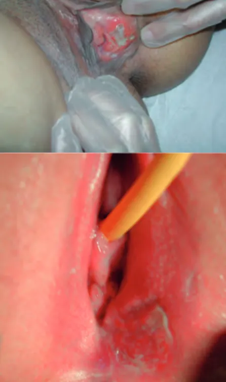 Figura 1. Úlcera vulvar en las pacientes des- des-critas.