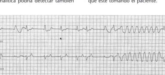 Figura  5. Episodio  de  taquicardia  ventricular  autolimitada  en  un  varón  de  78  años,  con  una  intoxi- intoxi-cación digitálica grave (digoxinemia de 8,4 ng/mL) e insuficiencia renal (creatinina 5 mg/dL).