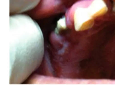 Figura 1. Lesión protuberante con base ne- ne-crótica y exposición de hueso en zona gingival superior izquierda, a nivel de piezas dentarias 23-24, compatible con osteonecrosis maxilar.