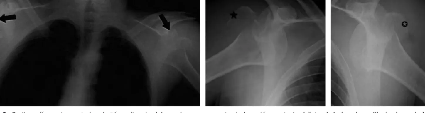 Figura 1. Radiografía posteroanterior de tórax (izquierda) en el que se muestra la luxación posterior bilateral de hombros (flechas) asociado a frac- frac-tura de troquiter humeral bilateral (centro estrella; derecha, círculo).
