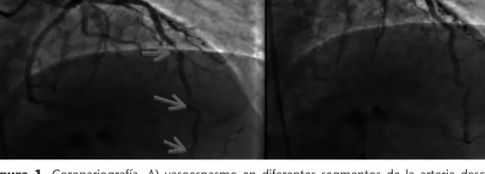 Figura 1. Coronariografía. A) vasoespasmo en diferentes segmentos de la arteria descendente anterior (flechas) .B) Resolución tras nitroglicerina intracoronaria.