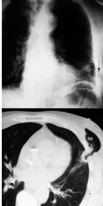 Figura 1. Radiología simple de tórax (superior). Se aprecia contusión pulmonar izquierda en relación con una fractura de la 7ª costilla izquierda e imagen compatible con hernia  inter-costal en el 7º espacio interinter-costal izquierdo (flecha)