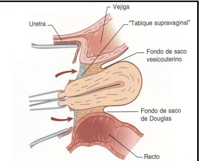 Gráfico de la realización de una Histerectomía Transvaginal 