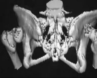 Figura 1. Reconstrucción de la tomografía computarizada (TC) 3D: luxación bilateral de cadera.