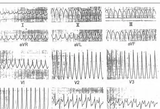 Figura 3. El trazo pertenece a un paciente con antecedente de infarto de miocardio que presentaba síncopes bruscos