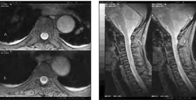 Figura 3. Esclerosis múltiple. Imágenes potenciadas en T2 de la columna cervical en el plano sagital