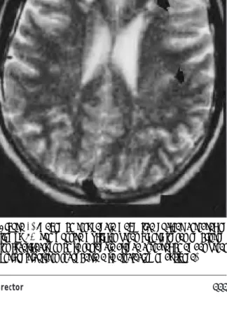Figura 1. Imagen de resonancia magnŽtica nuclear cerebral en tiempo T2, que muestra mœltiples ‡reas hiperintensas en  diferen-tes localizaciones de la sustancia blanca cerebral de ambas ‡reas periventriculares secundaria a la afectaci—n embol’gena.