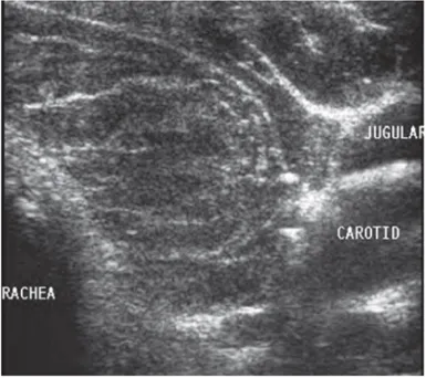 Figura 10. Lóbulo tiroideo izquierdo en paciente con tiroiditis de Hashimoto. Fibrosis  avanzada con patrón lineal hiperecoico