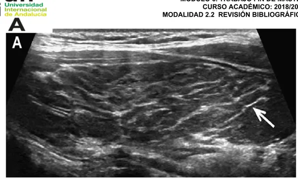 Figura 15. Septos hipoecoicos gruesos en la tiroiditis de Hashimoto, con múltiples  líneas fibrosas de separación ( flecha )