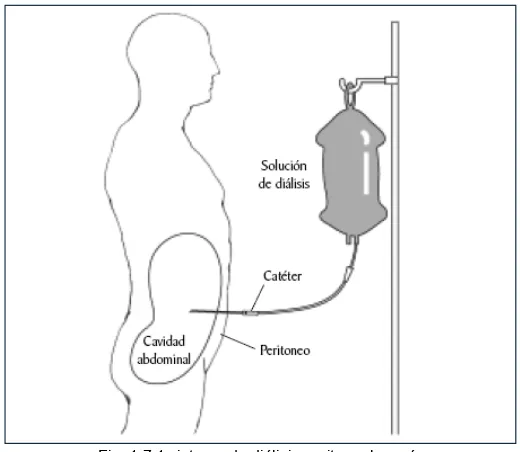 Fig. 1.7.1 sistema de diálisis peritoneal común   