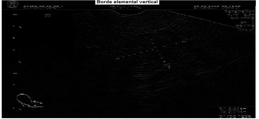 Fig. 5.5  Operador elemental vertical.