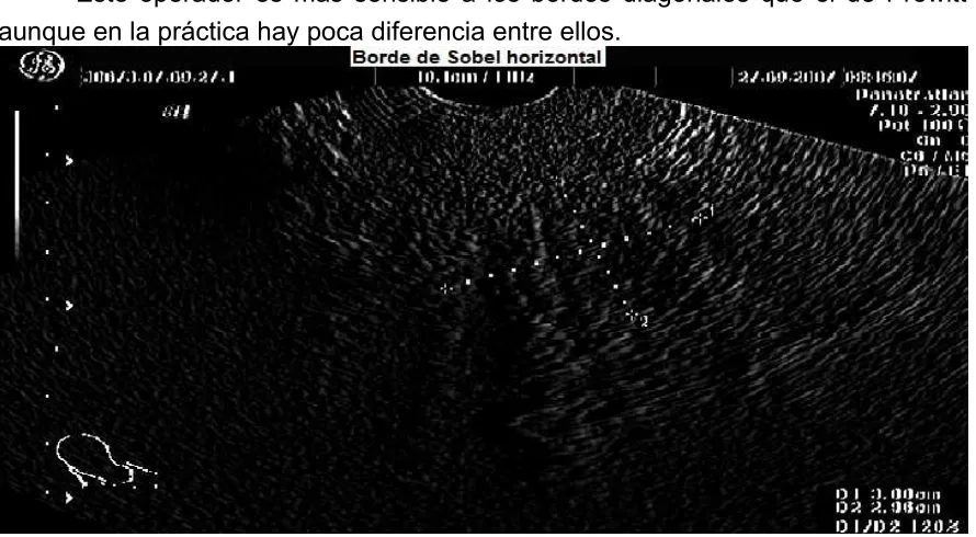Fig 5.9  Operador de Prewitt vertical.