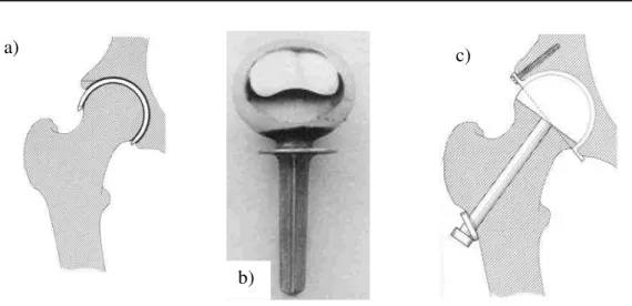 Figura I.3.-  Diversos diseños de prótesis 
