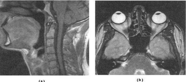 Fig. 2.8  (a) Ejemplo de una imagen sagital del cuello, mostrando los discos. (b) Imagen transversal de la  cabeza [20]