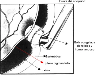 Figura 1.3.2 Aplicación de la punta del críopobo sobre lesiones retinianas en el globo ocular 