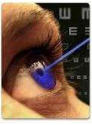 Figura 3.13 Operación ocular con laser. 