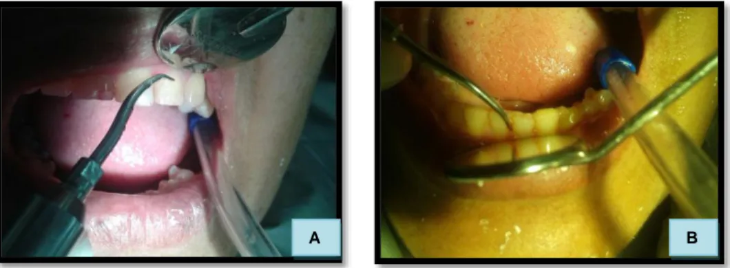 Figura 9. Profilaxis 1 (a) Maxilar superior. (b) Maxilar inferior.  Fuente  y  elaborador: Ana Zurita C