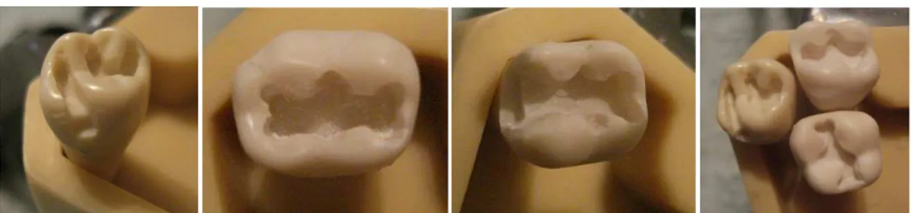 Figura  4.2  Cavidades  más  representativas  en  el  primer  molar  permanente  para  colocación  de  amalgamas