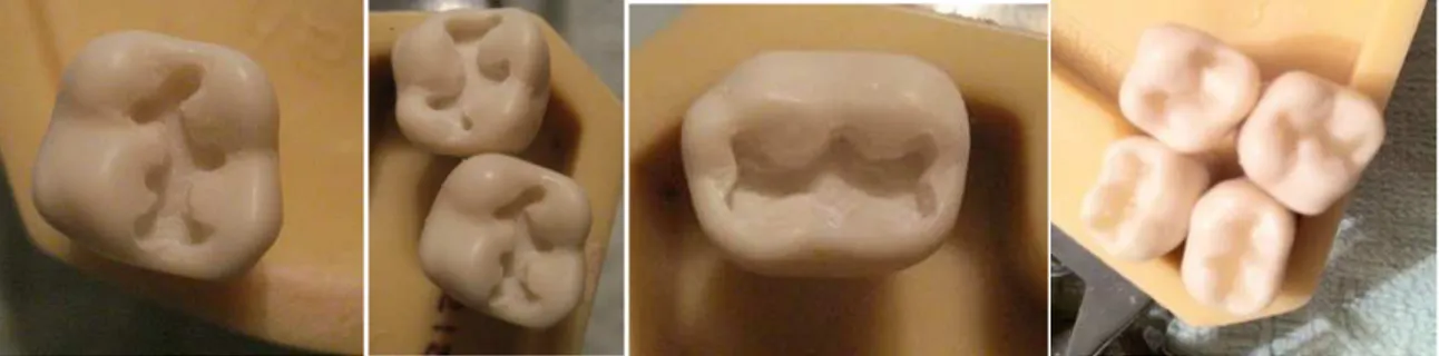 Figura 4.3  Cavidades más representativas en el primer molar para colocación de resinas