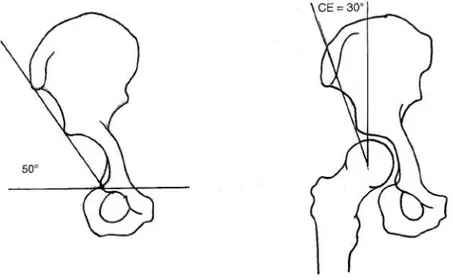 Figura II.18.- Ángulo de inclinación del cotilo (izquierda). Ángulo de cobertura CE 