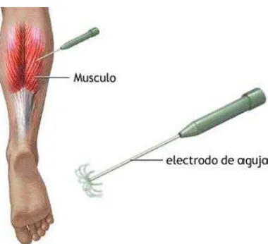 Figura II.15.- Colocación típica de electrodos superficiales en bíceps braquial. 