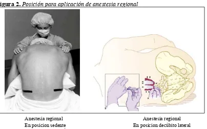Figura 2. Posición para aplicación de anestesia regional 