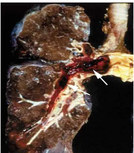 Figura 1. Trombo en arteria pulmonar.  