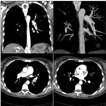 Figura 6. Defectos de repleción arteria pulmonar, TCH. 