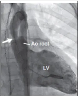 Figure 2. Left ventriculography shows 