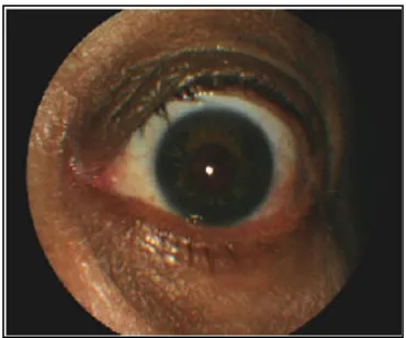 Figure 5. Stellate iris pattern of a patient with WBS (Modified 