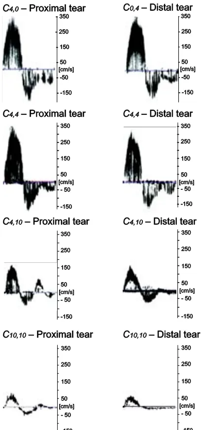 Figure 3.6: Velocities through the tears in different morphologic configurations: with only one small tear; two small tears; one small tear and one large tear; and two large tears