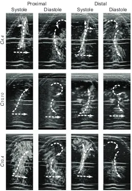 Figure 3.10: Flow patterns within the dissected models at peak systole and peak diastole