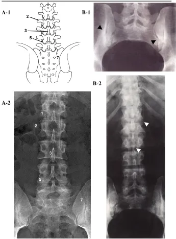 Figura 3. A-1) Esquema de una vista postero-anterior  de una columna vertebral lumbar normal