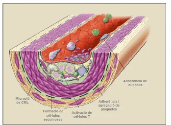 Fig 2. Formació de l’estria grassa. L’acúmul de macròfags i CML poden ocasionar un engruiximent de la paret arterial conegut com a estria grassa