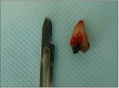 Figura 11. Exodoncia del diente 1.4. Contraindicado un tratamiento protésico 