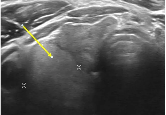 Figura 76. Nódulo de mayor ecogenicidad (hiperecoico) respecto al parénquima tiroideo