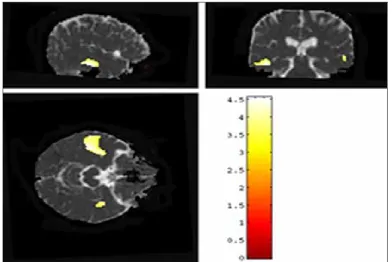 Fig. 2 Sagital, coronal and axial MRI images showing increased ADC in the temporal white matter in schizophrenic patients compared to controls