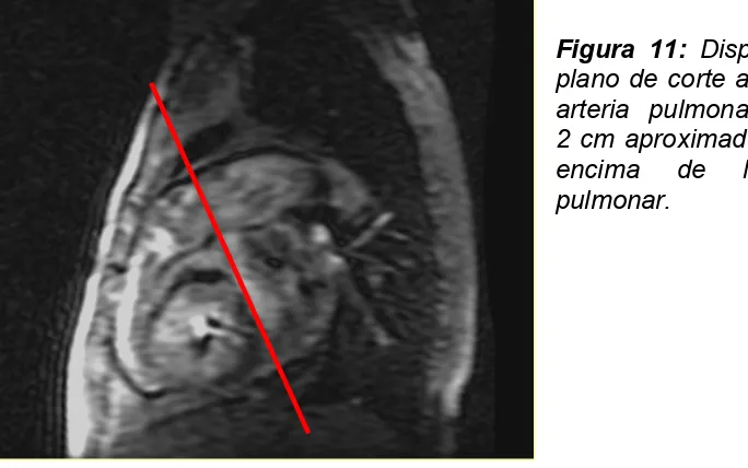 Figura 11: Disposición del plano de corte a nivel de la arteria pulmonar principal.  2 cm aproximadamente por encima de la válvula pulmonar.