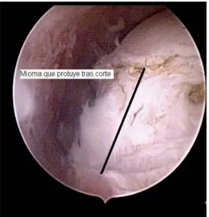 Fig. 34 Mioma que protuye tras sección de mucosa y pseudocapsula 