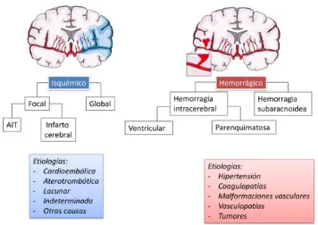 Figura 1: Subtipos de ictus y etiologías. AIT: ataque isquémico transitorio 