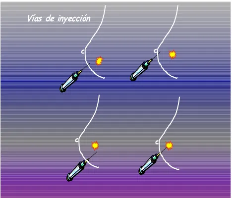 Figura 1. Esquema de las distintas vías de administración del radio coloide (de arriba abajo y de izquierda a derecha): subdérmica, areolar, peritumoral e intraumoral 