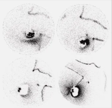 Figura 2: Cáncer mama izquierda, inyección CSE. Proyecciones gammagráficas (anterior en decúbito, anterior en bipedestación, oblícua anterior izquierda, lateral izquierda)