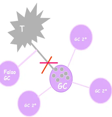 Figura 6: Falso GC, infiltración del auténtico GC por células  metastásicas. 