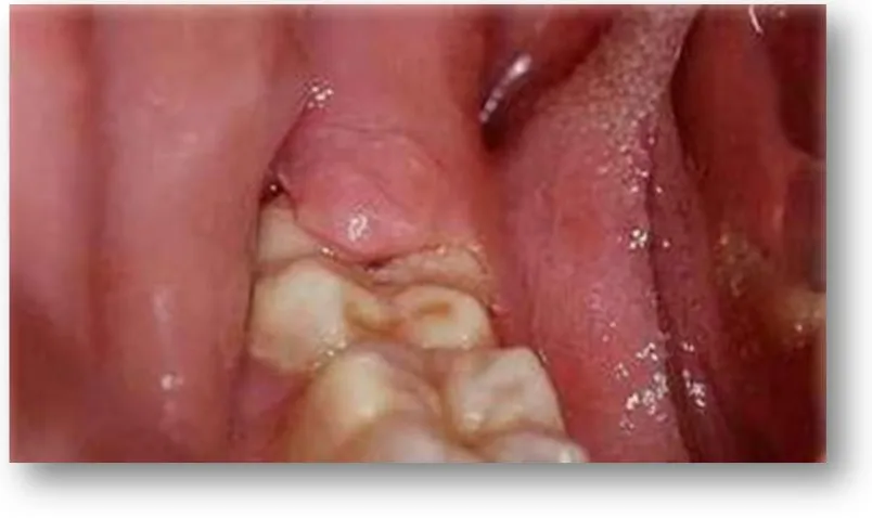 Figura 2: Pericoronaritis en el tercer molar inferior (foto del autor de la presente tesis)