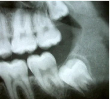 Figura 3: Radiografía del tercer molar inferior con pericoronaritis, evidenciando la 