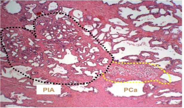 Figura 3: Contigüidad entre PIA y cáncer de próstata. 